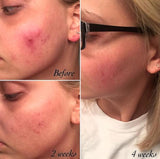 Timeless 3-Step Acne System - Vegan Concept