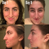Timeless 3-Step Acne System - Vegan Concept