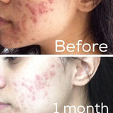Timeless 3-Step Acne System - Vegan Concept