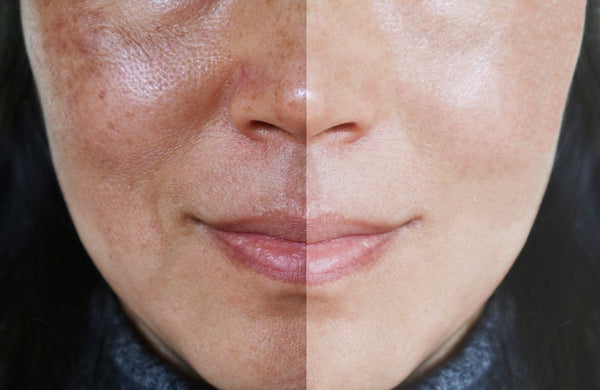 Correcting Uneven Skin Tone