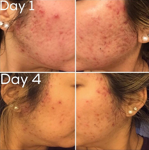 Timeless 3-Step Acne System - Vegan Concept